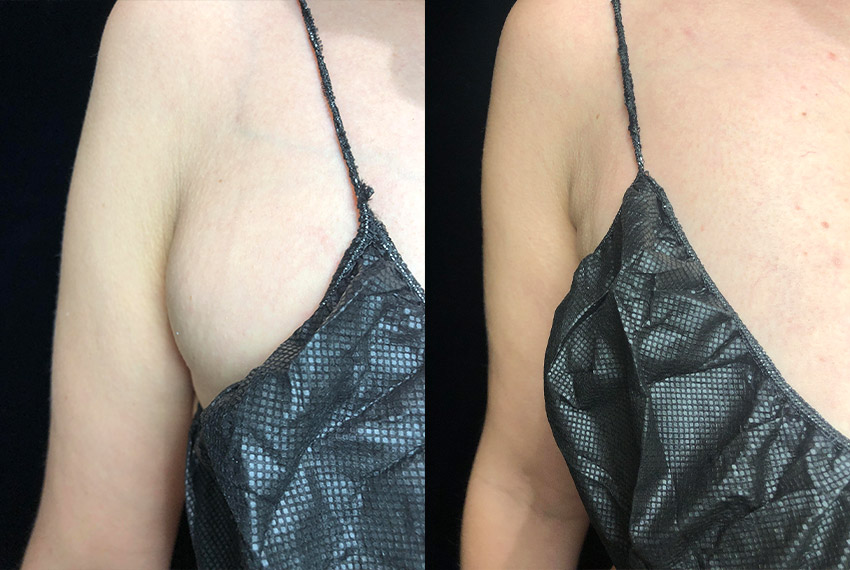 Smartlipo Before & After 23