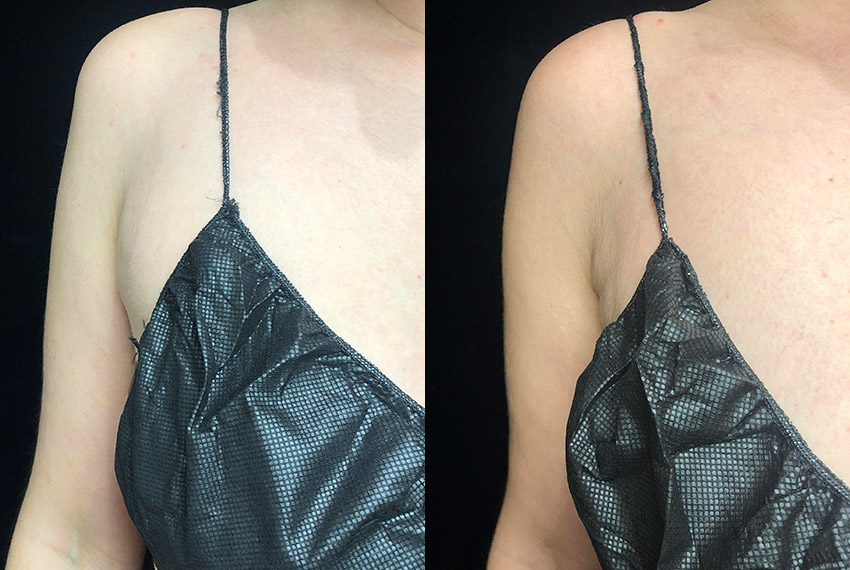 Smartlipo Before & After 23