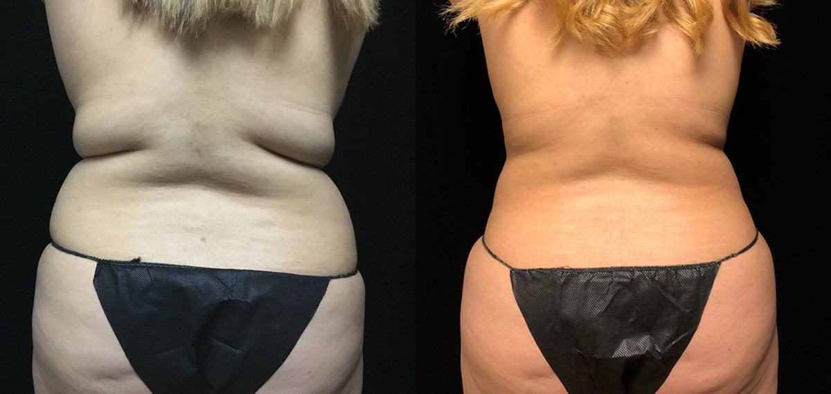 Smartlipo Before & After 25