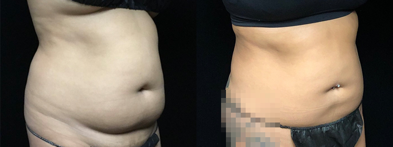 Smartlipo Before & After 26