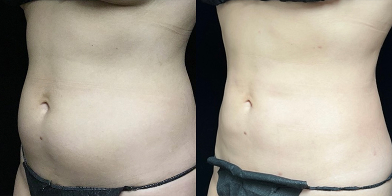 Smartlipo Before & After 28