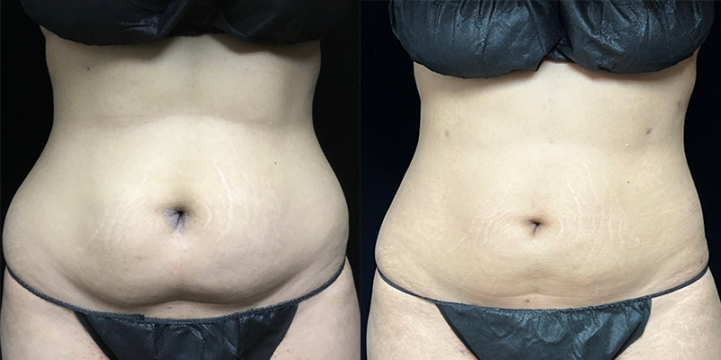 Smartlipo Before & After 29