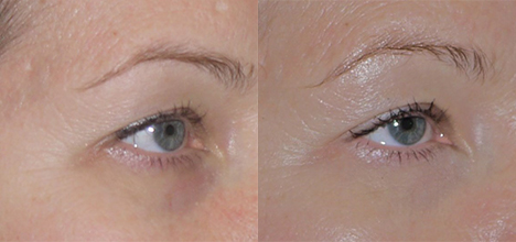 Thermage Before & After 1