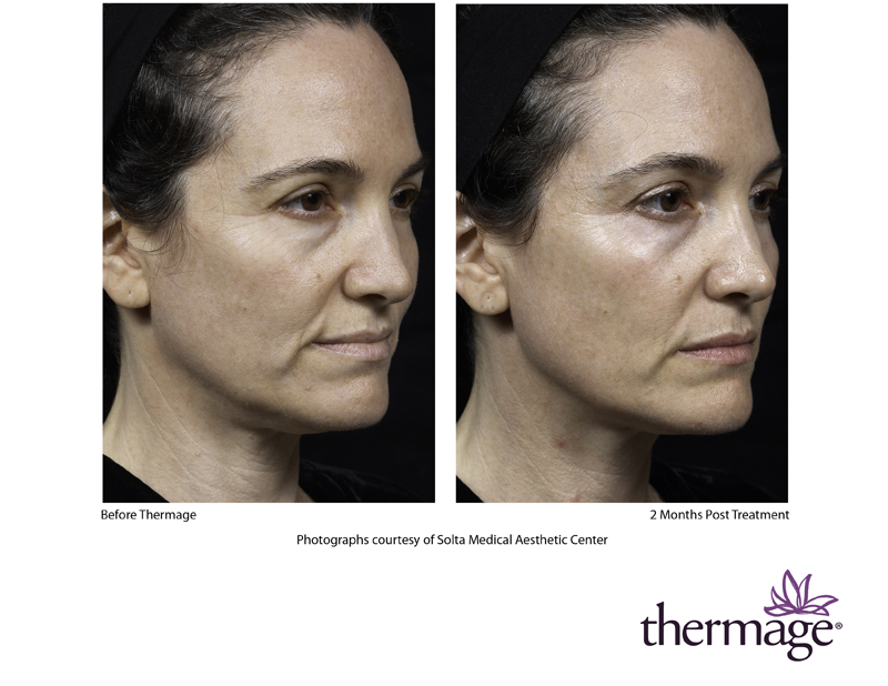 Thermage Before & After 3