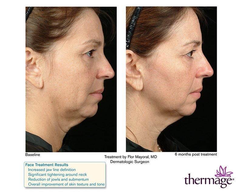 Thermage Before & After 5