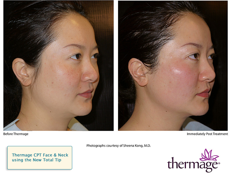 Thermage Before & After 6