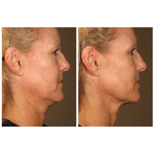 Ultherapy Before & After 1