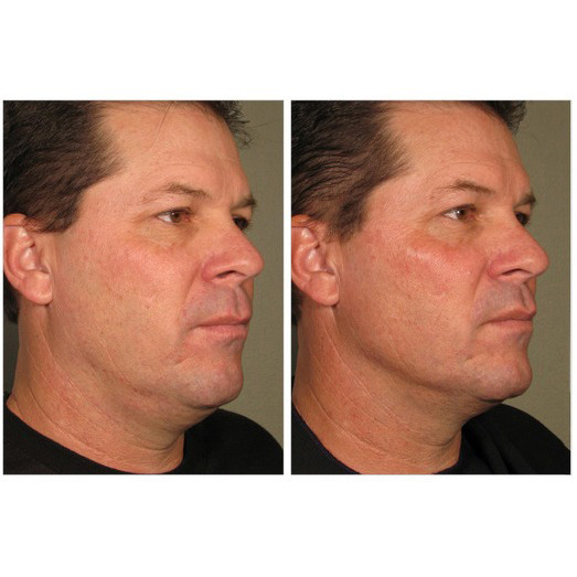 Ultherapy Before & After 2