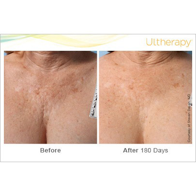 Ultherapy Before & After 3