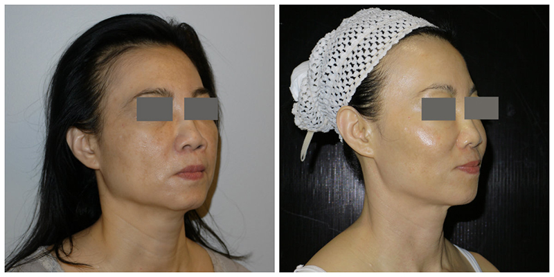 Ultherapy Before & After 4