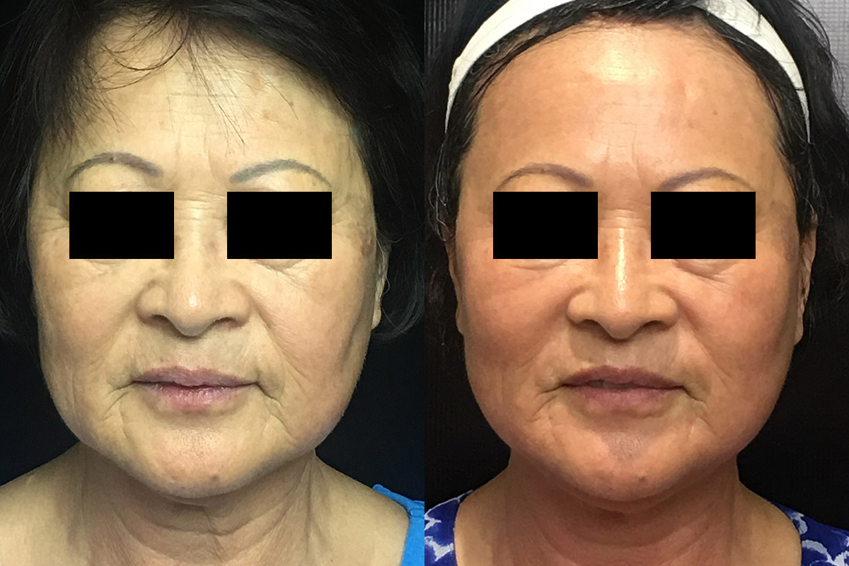 Ultherapy Before & After 5