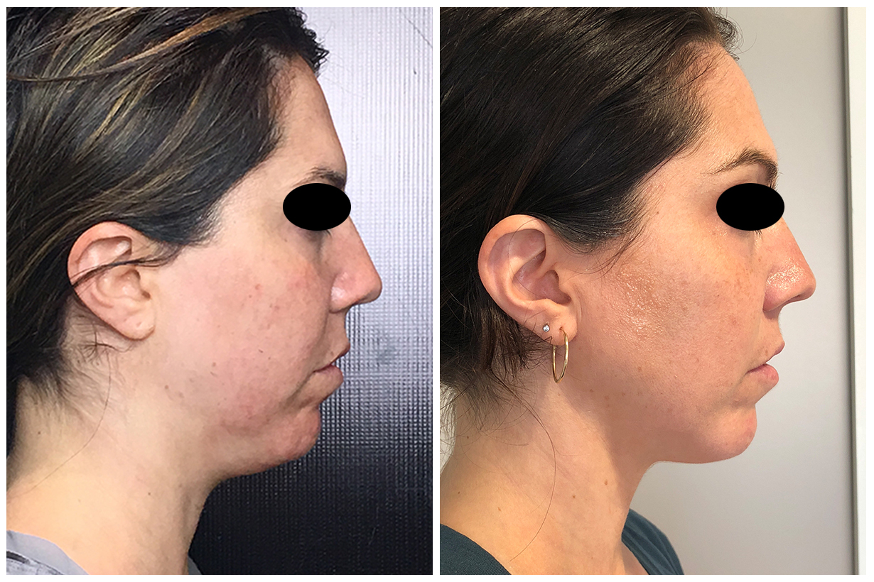 Ultherapy Before & After 6