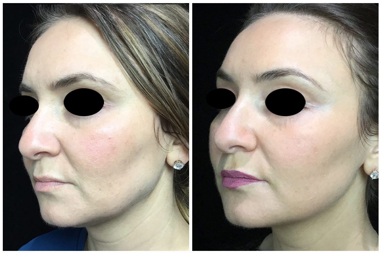 Ultherapy Before & After 8